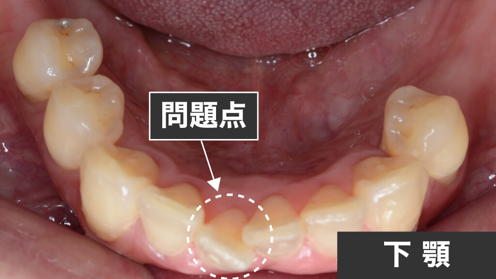 ②下前歯部の傾斜の問題