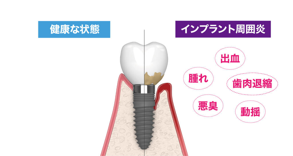 インプラント周囲炎の原因 | インプラント周囲炎 画像 – RJWVKQ