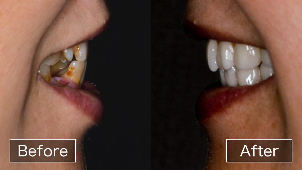 術前術後の前歯の噛み合わせ比較
