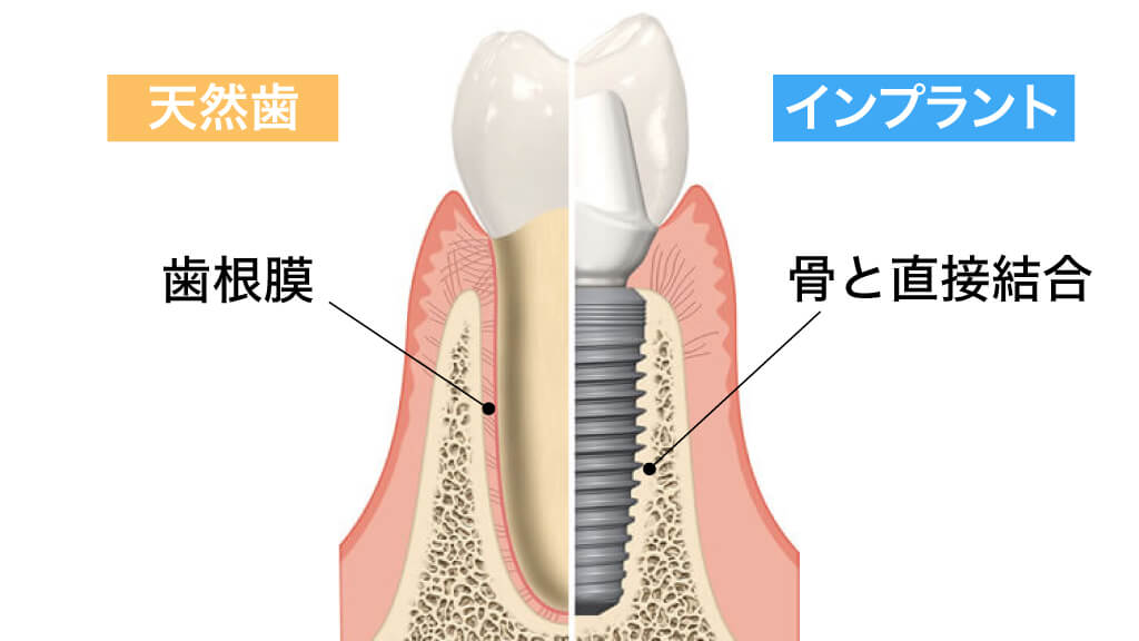 新井歯科クリニック｜インプラント