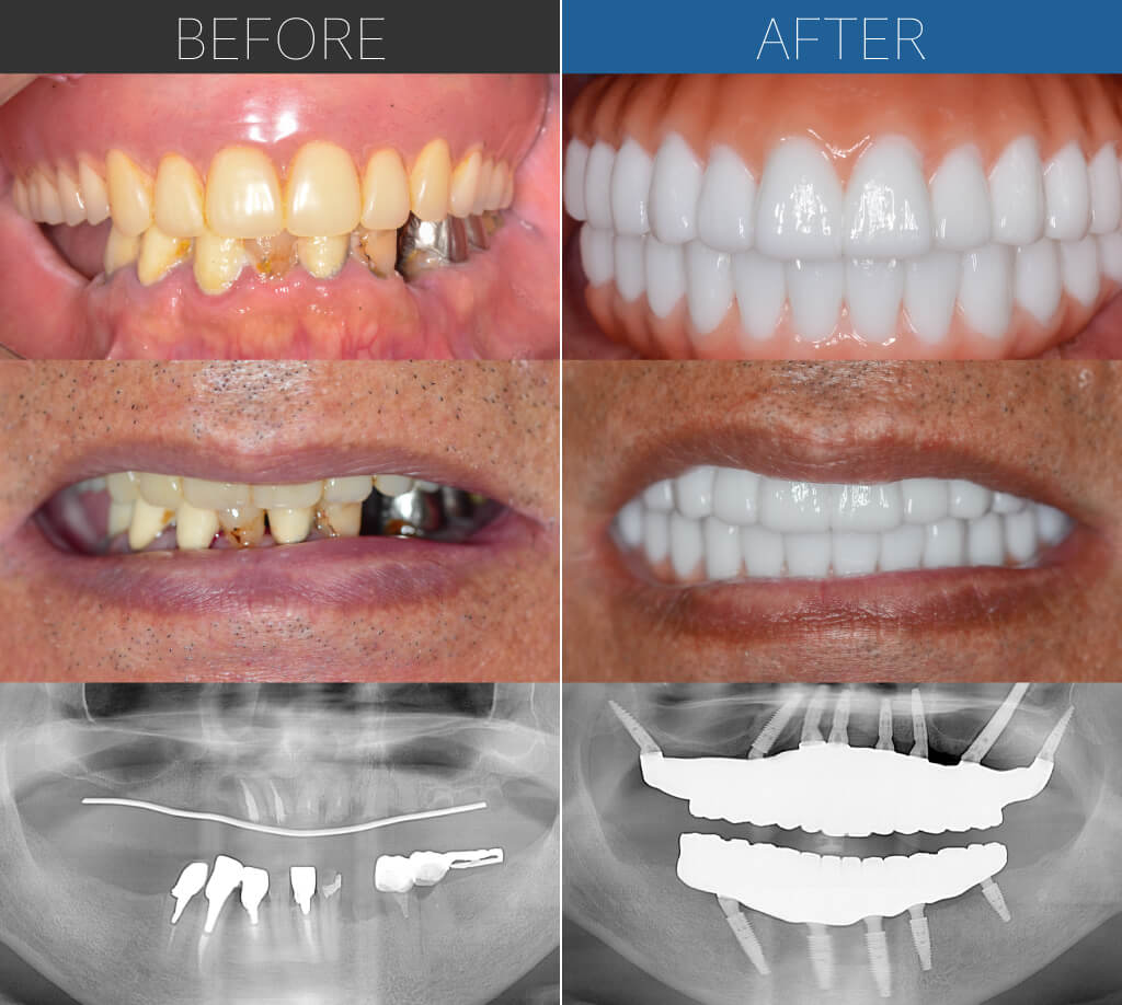 1105オールオン4