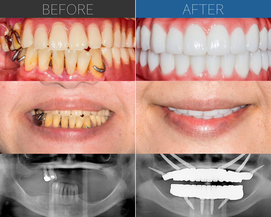 1149オールオン4クワッドザイゴマ