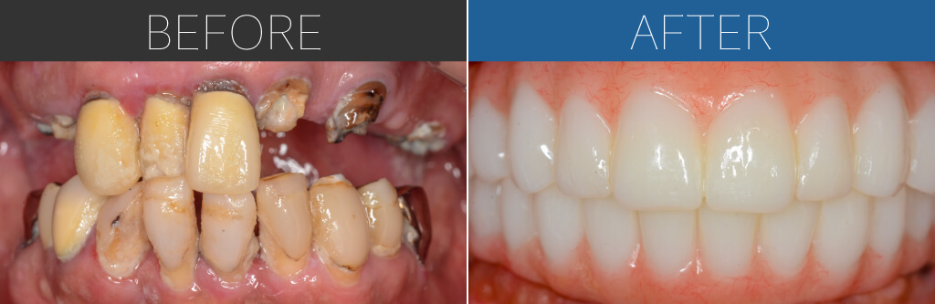 1209オールオン4症例写真