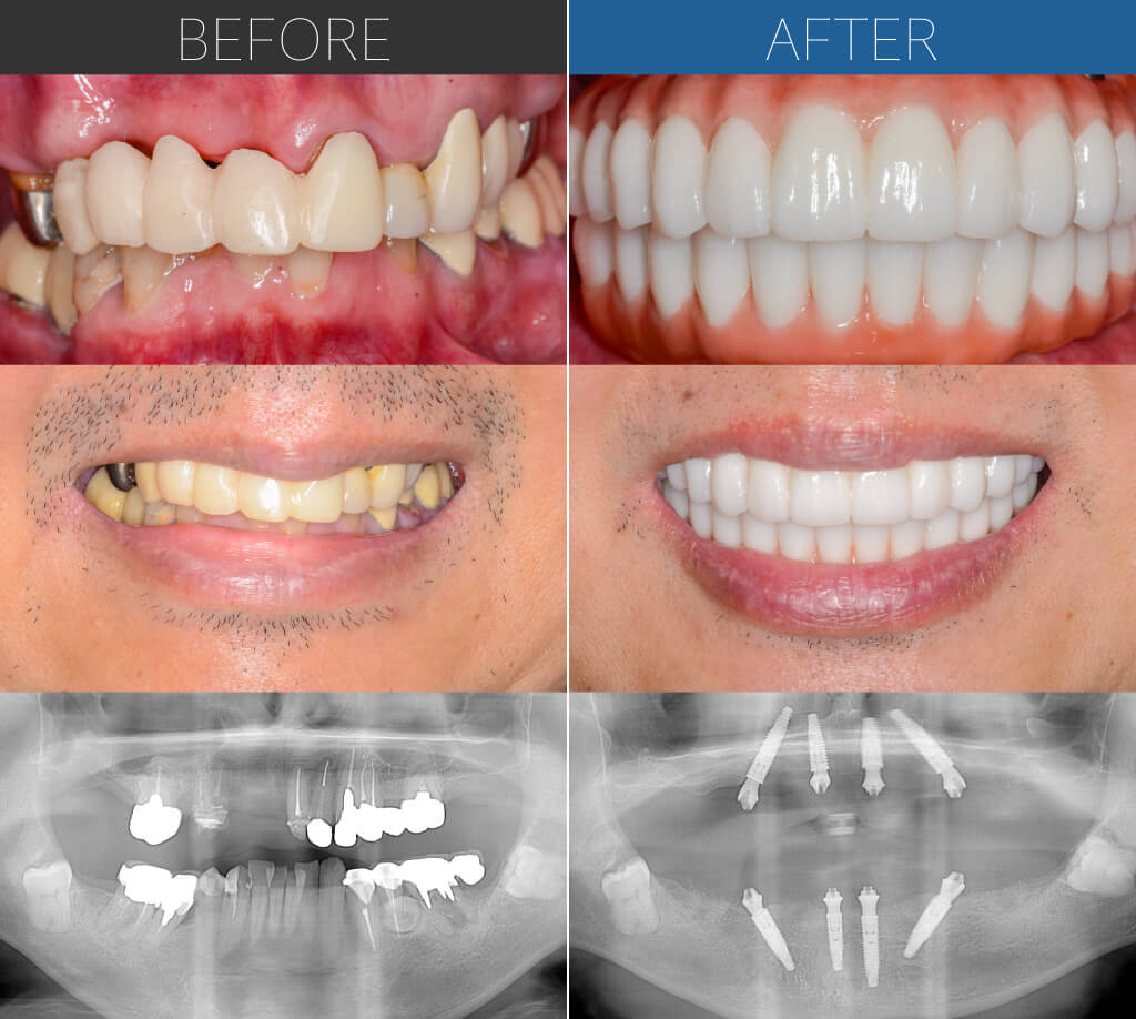 1331オールオン4症例写真