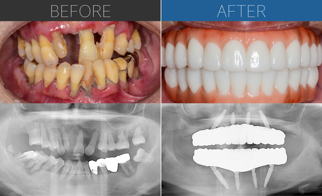 1347オールオン4症例写真