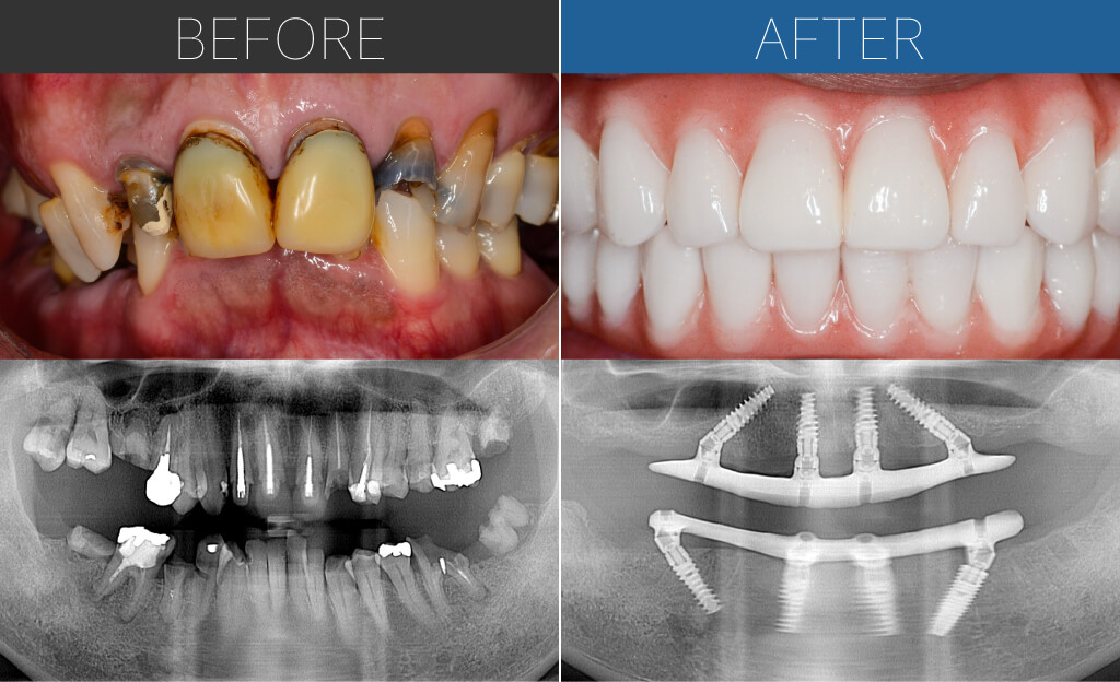 326オールオン4症例写真