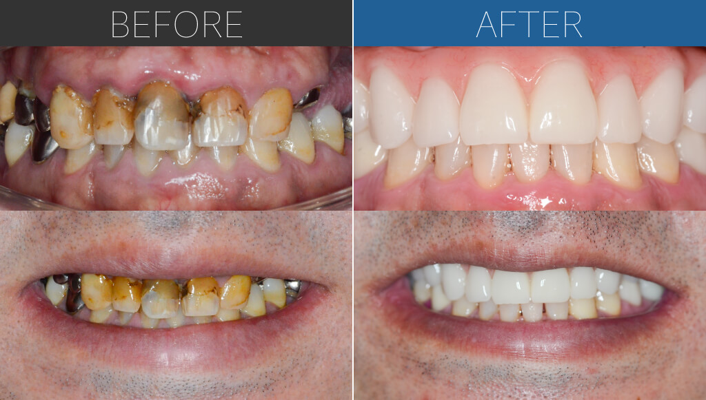 521オールオン4症例写真