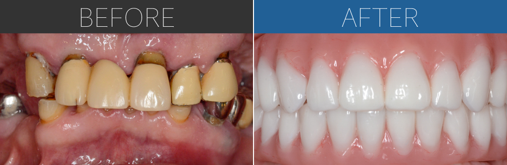 550オールオン4症例写真
