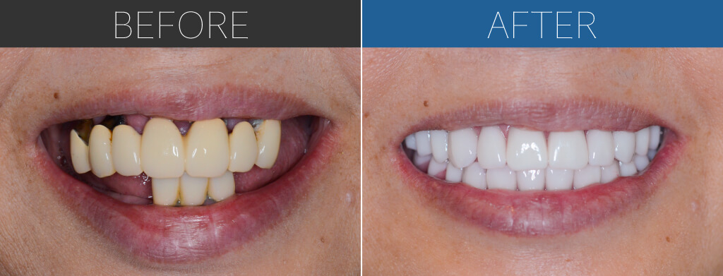 582オールオン4症例写真