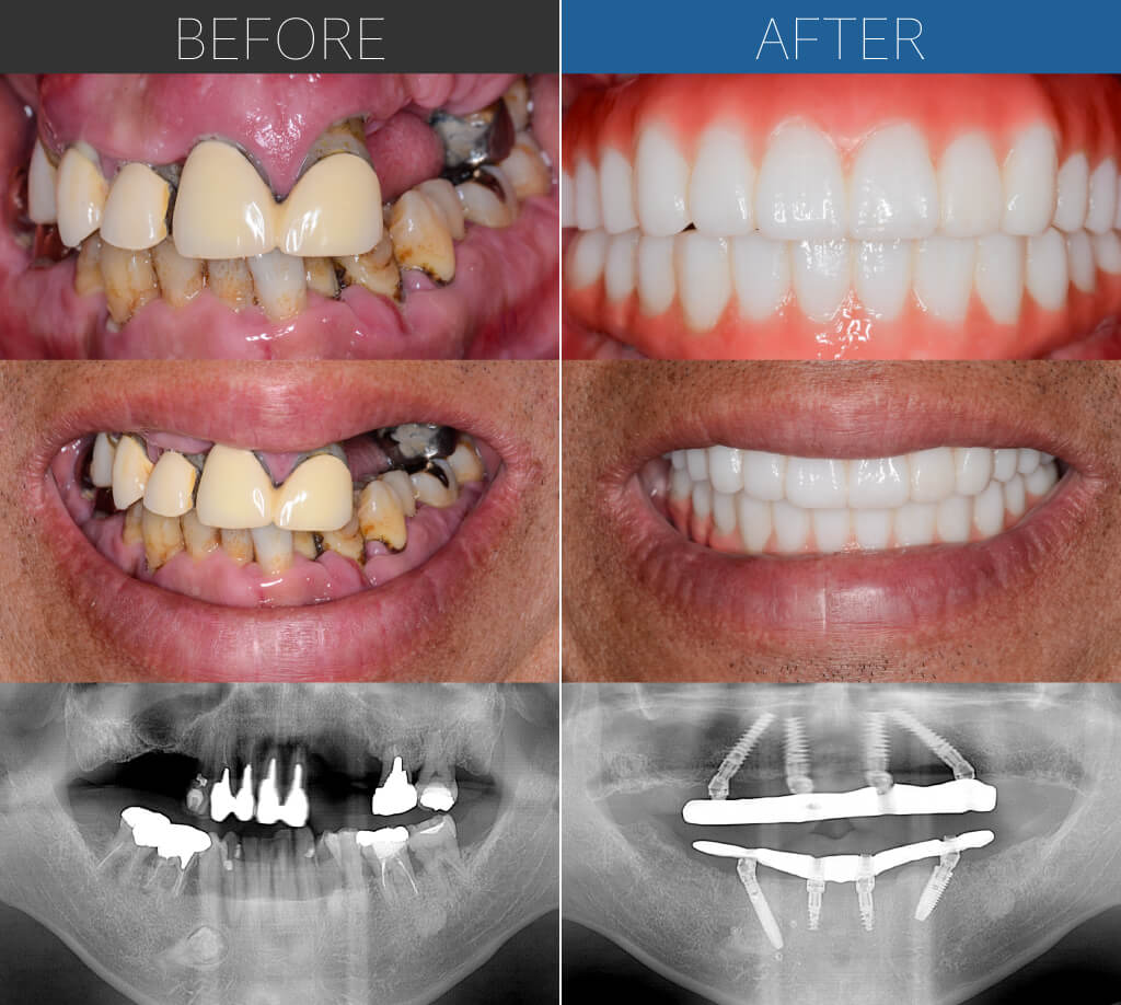874オールオン4症例写真