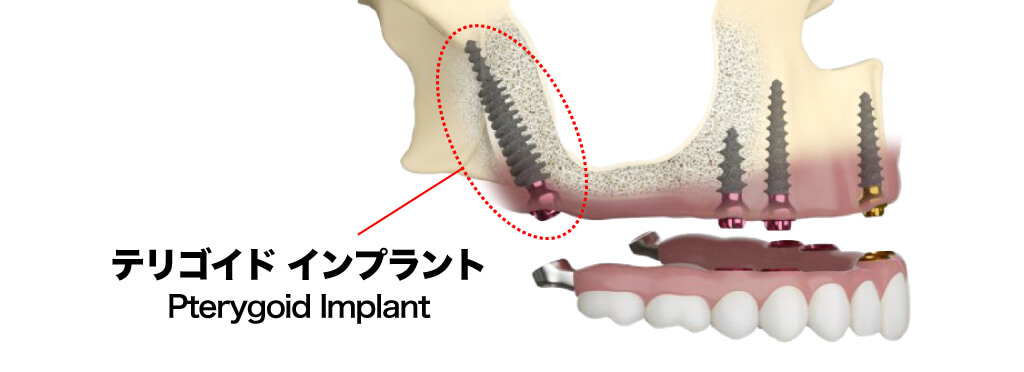 テリゴイドインプラントとは