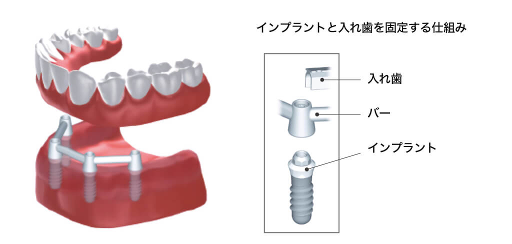 バーアバットメント