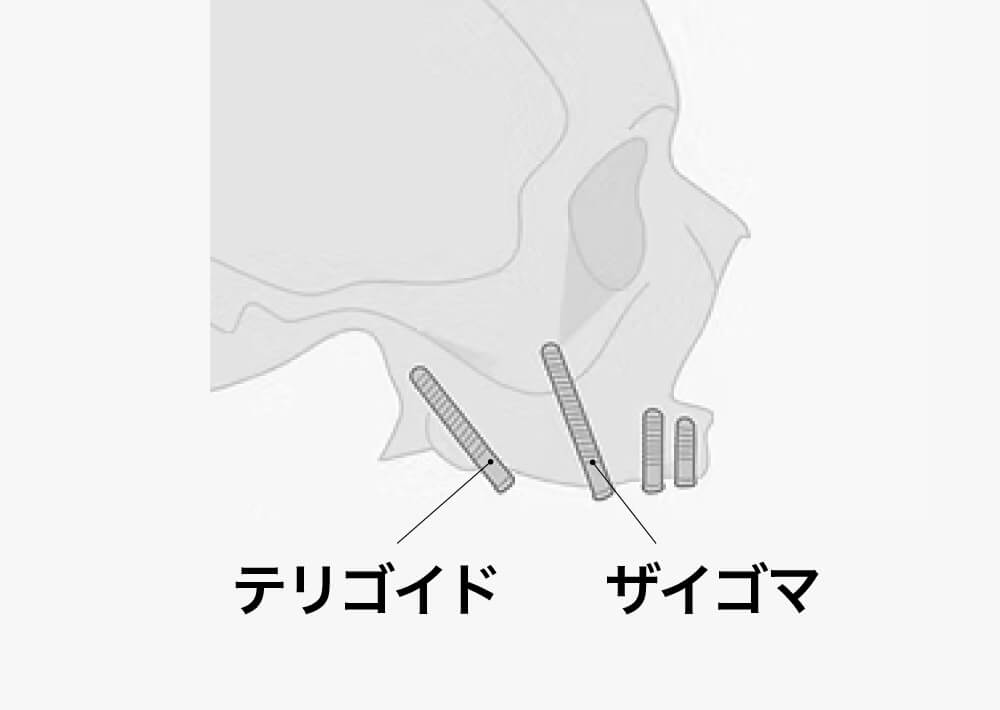 上顎右側治療計画