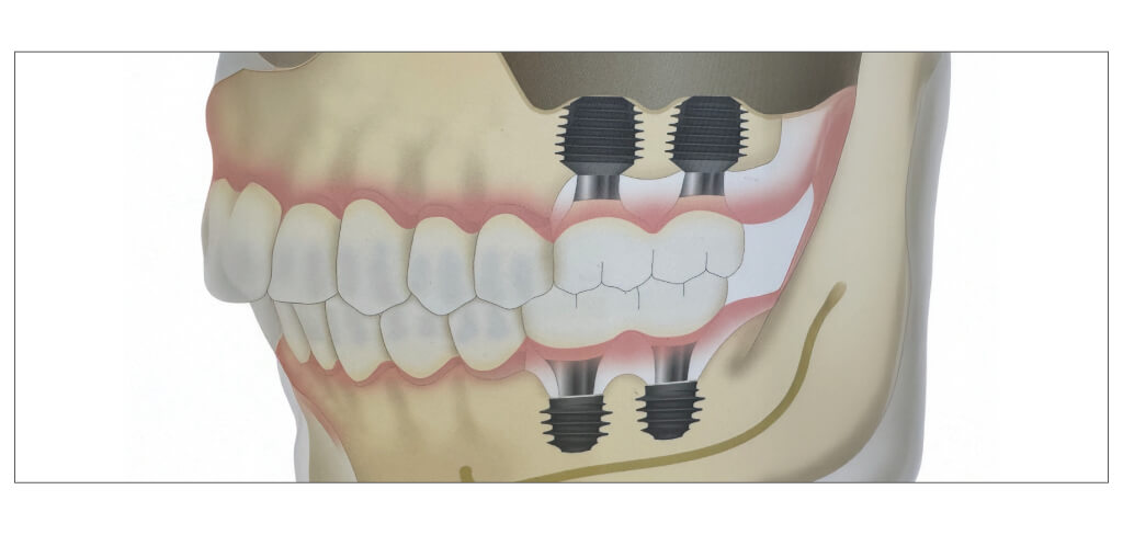 上顎左側ワイドショートインプラント