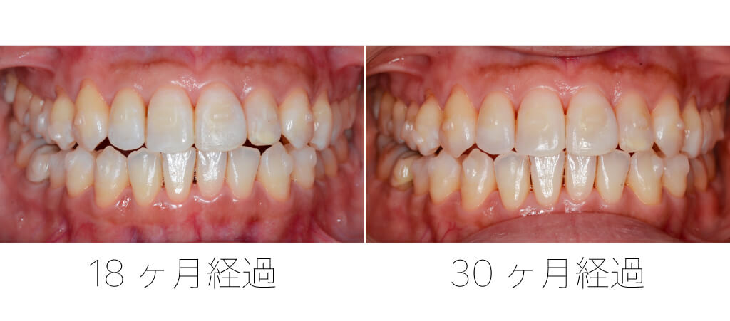 インビザライン経過30ヶ月