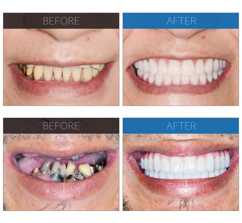 札幌で「オールオン4」ならGDHインプラントオフィス札幌