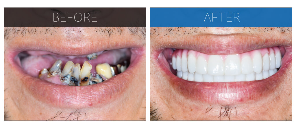 ひどい虫歯のオールオン4症例