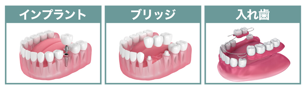 インプラント・ブリッジ・義歯