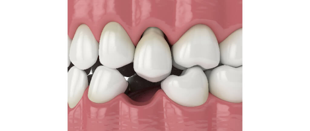 口の中を噛む原因_噛み合わせ