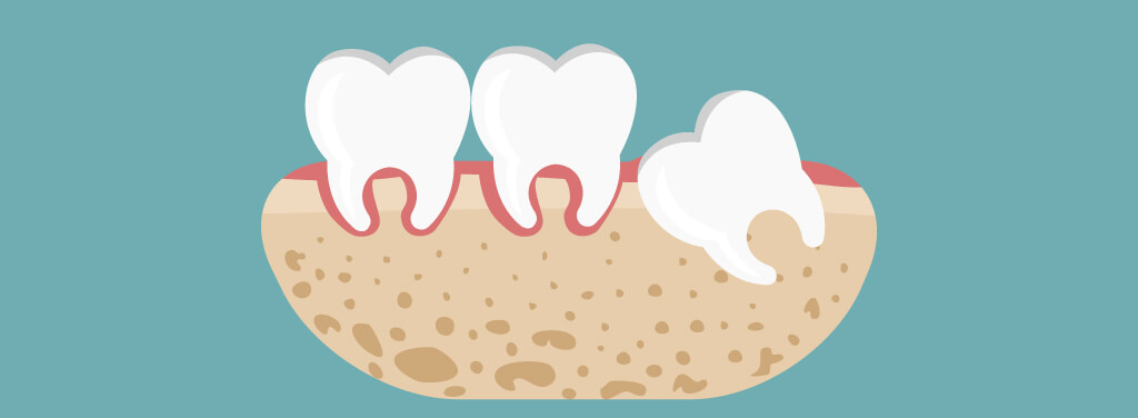 口の中を噛む原因_親知らず