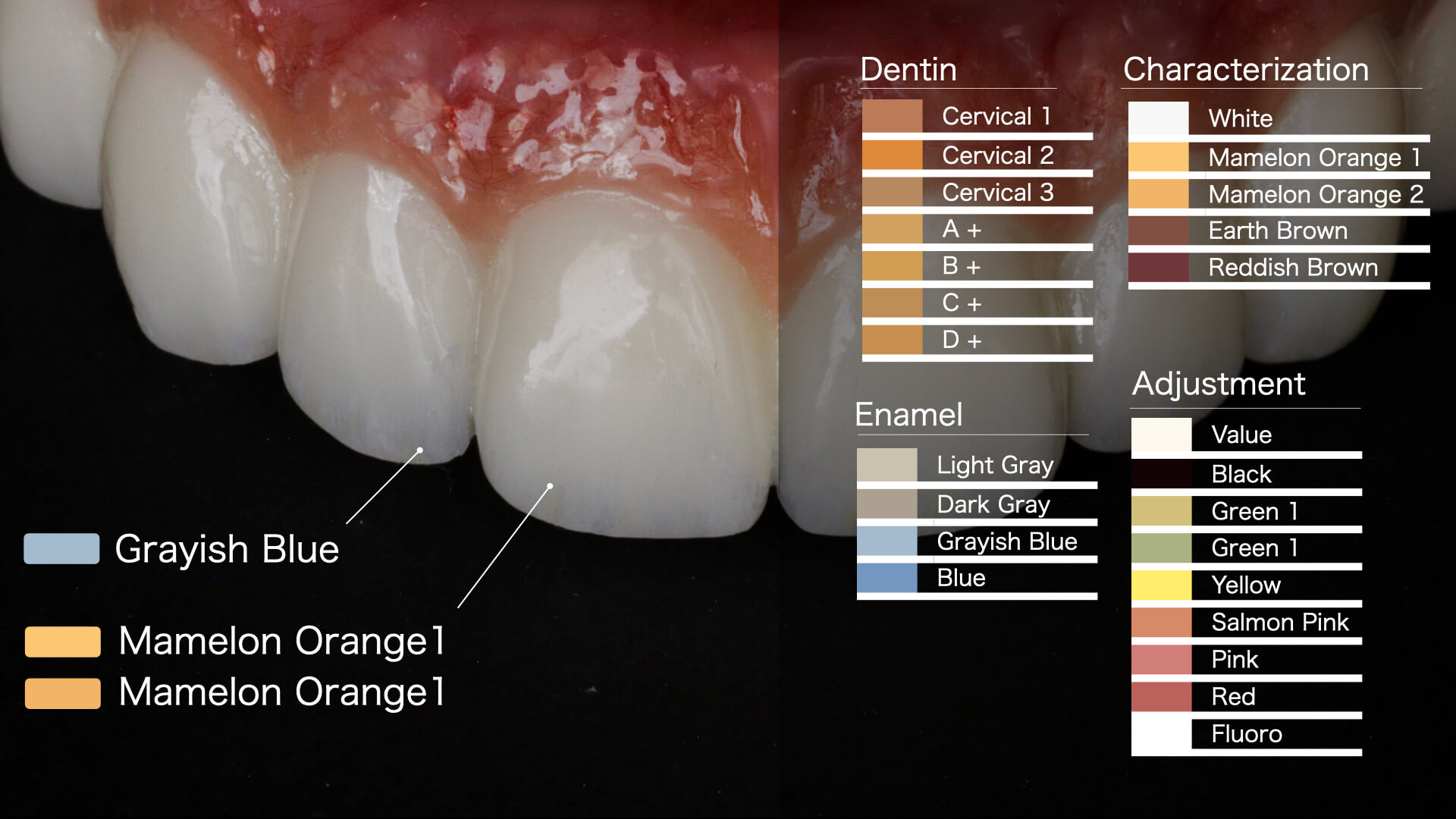 札幌で「オールオン4」ならGDHインプラントオフィス札幌