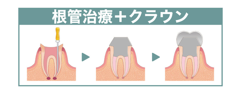 根管治療・クラウン