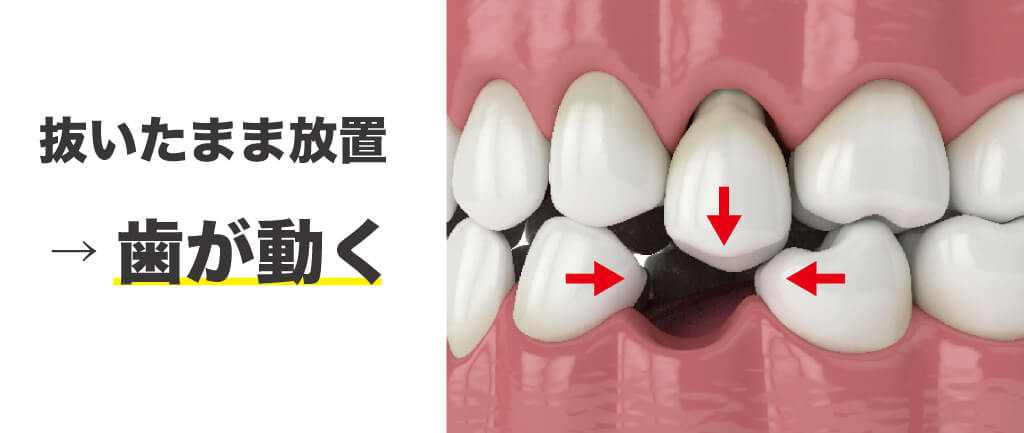 歯が抜けたまま放置