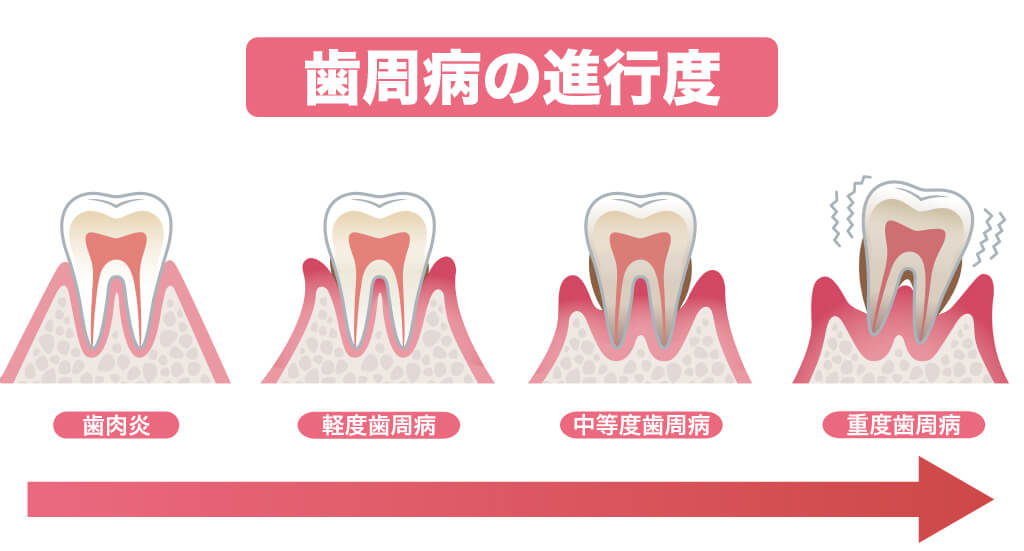 歯周病の進行度