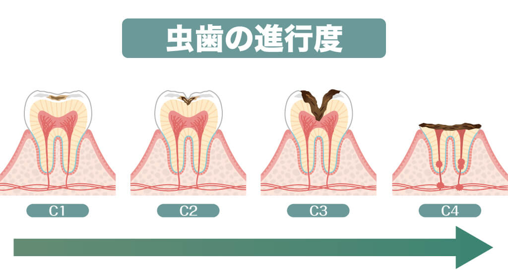 虫歯がひどくなる進行度