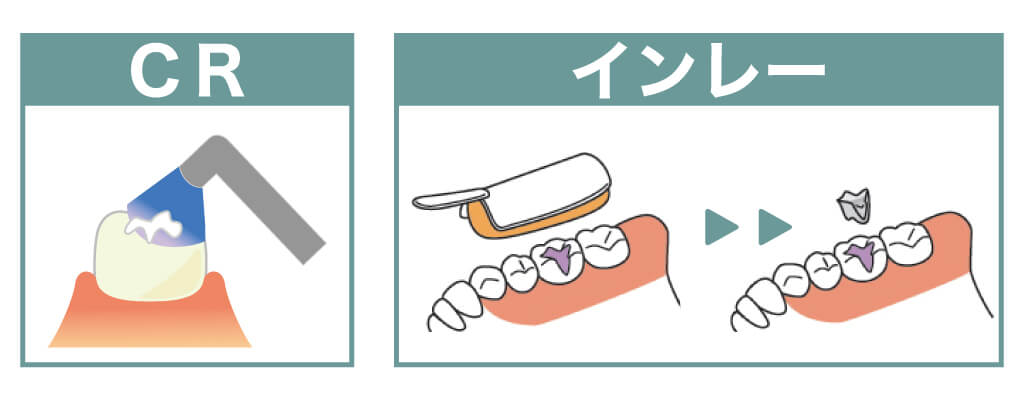 虫歯の治療方法CR・インレー