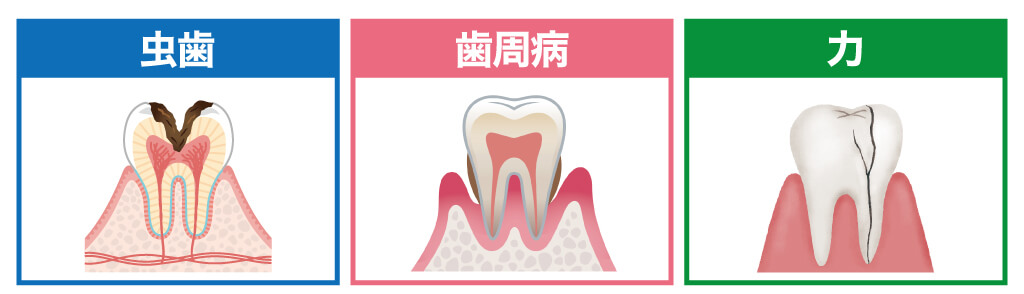 虫歯・歯周病・破折