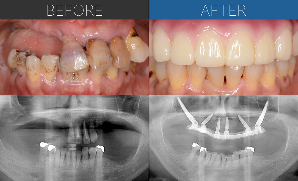 1028オールオン4