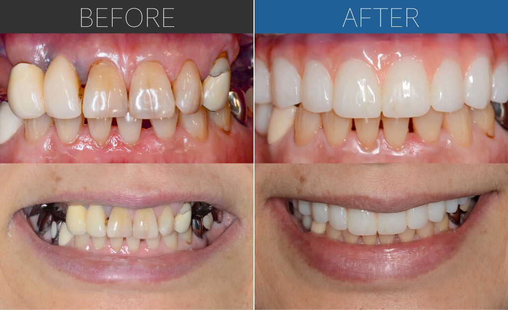 116上だけオールオン4