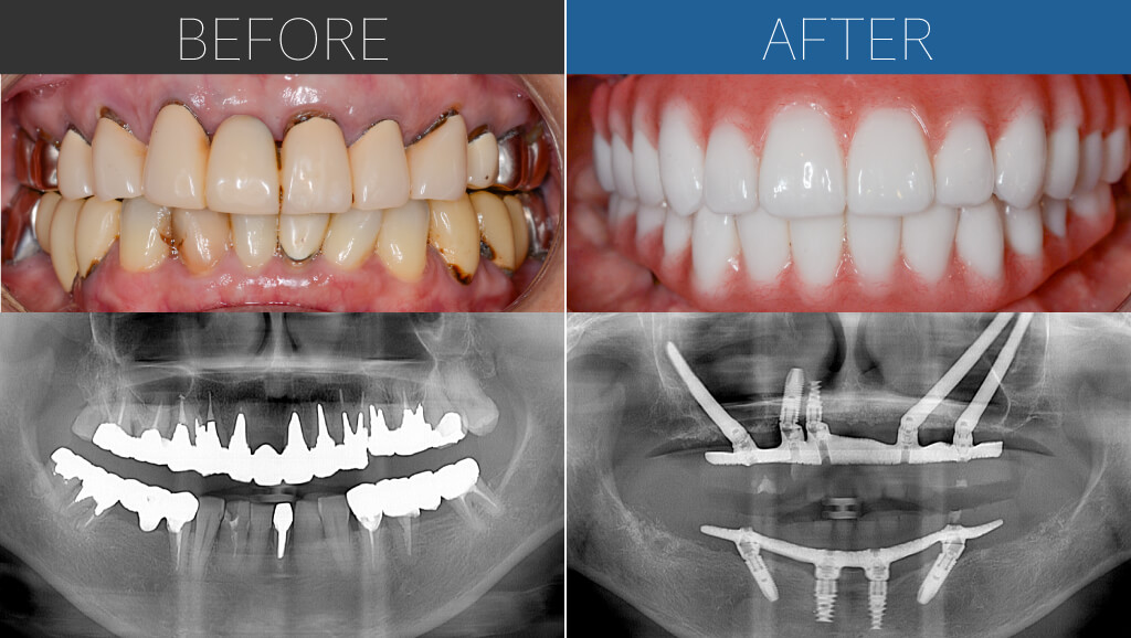 151オールオン4術前術後