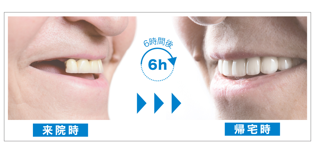 オールオン4メリット①1日で終わる