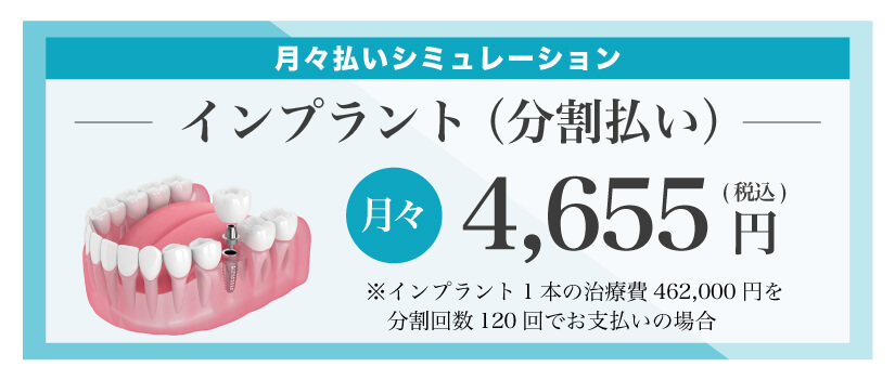 インプラント分割払いシミュレーション