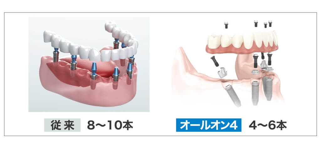 オールオン4メリット5本数が少ない