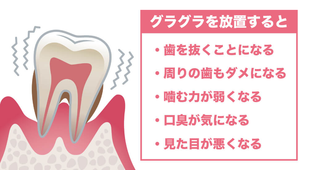 歯がグラグラするリスク