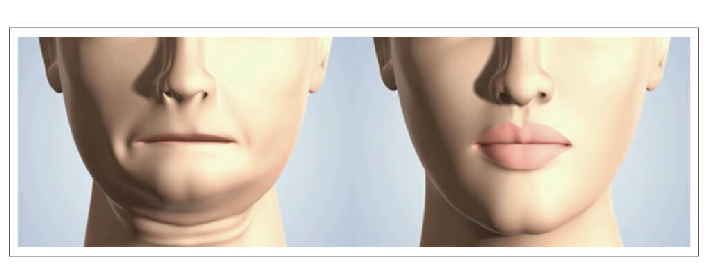 オールオン4メリット③顔貌が痩せない