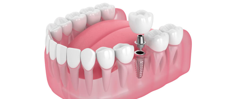 インプラント1本の相場