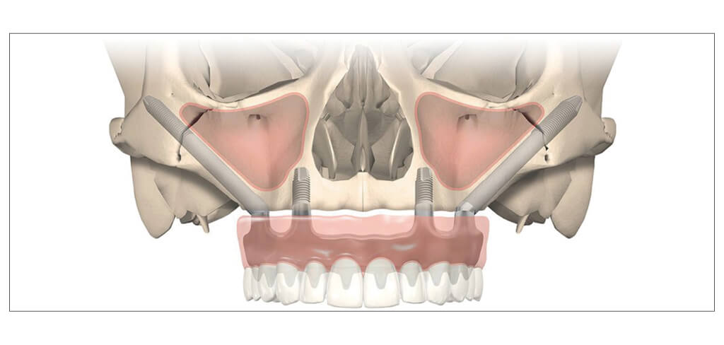 ザイゴマインプラント紹介