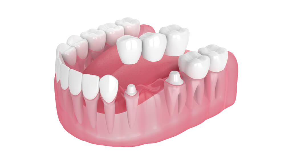 ブリッジ治療