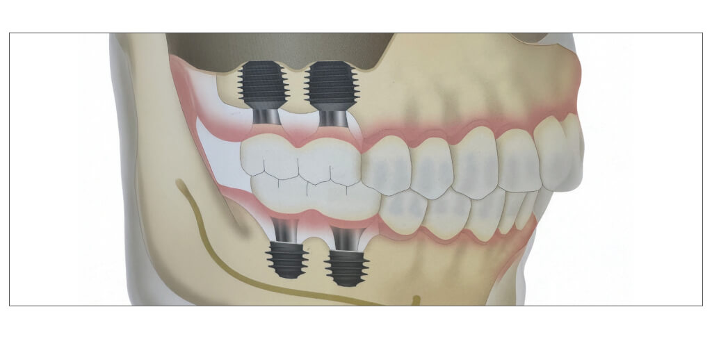 ワイドショートインプラント紹介