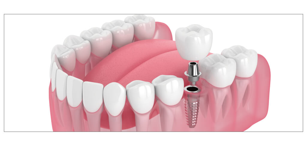 抜歯即時インプラント