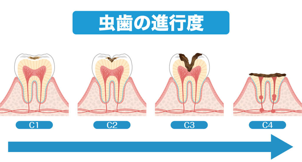 虫歯の進行度