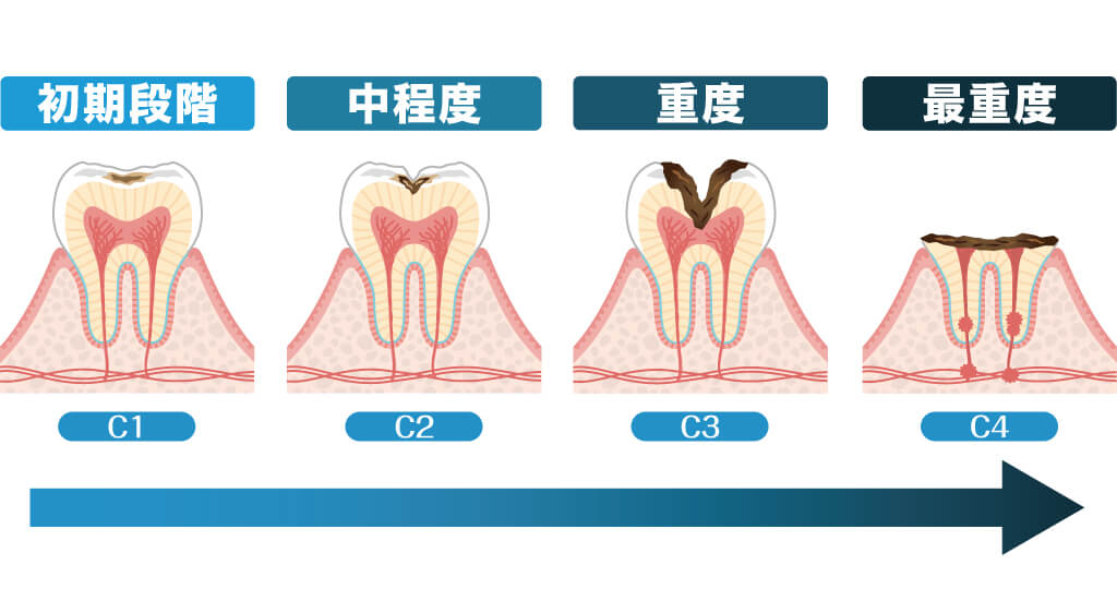 虫歯の進行度2