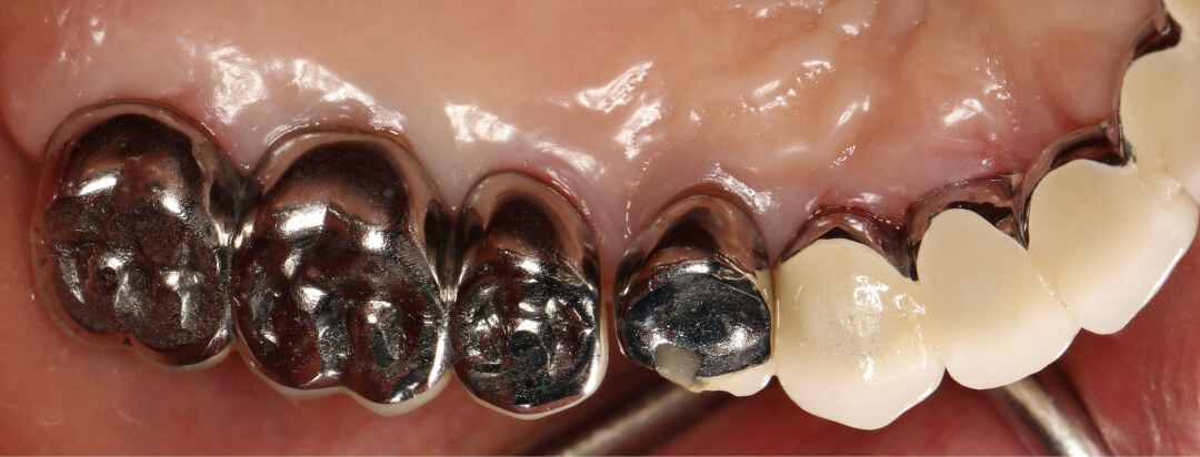 保険のブリッジ