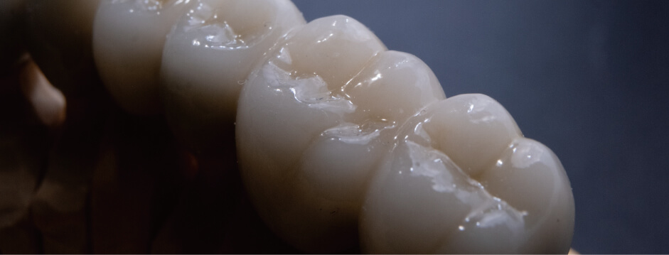 自費のブリッジ