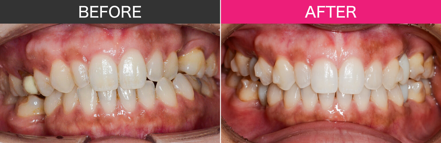 11.術前術後正面