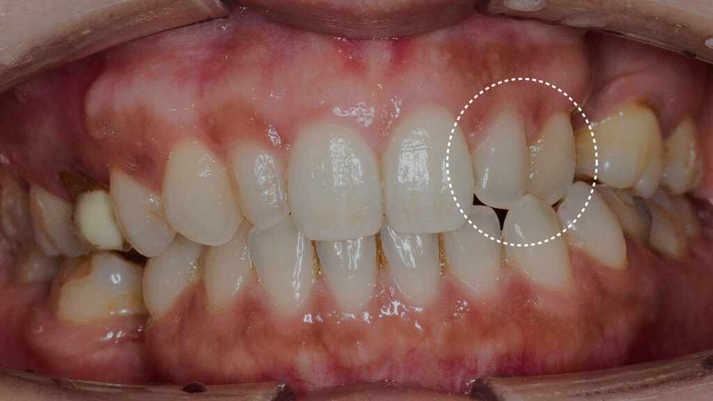 4.術前正面クロスバイト